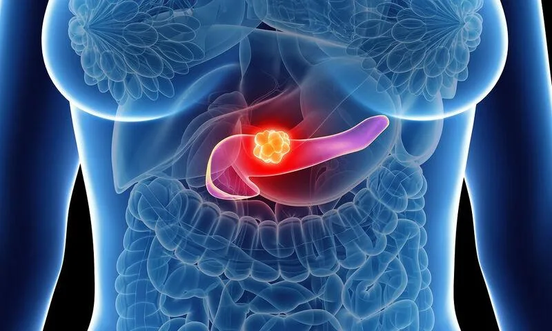 pancreatic cancer