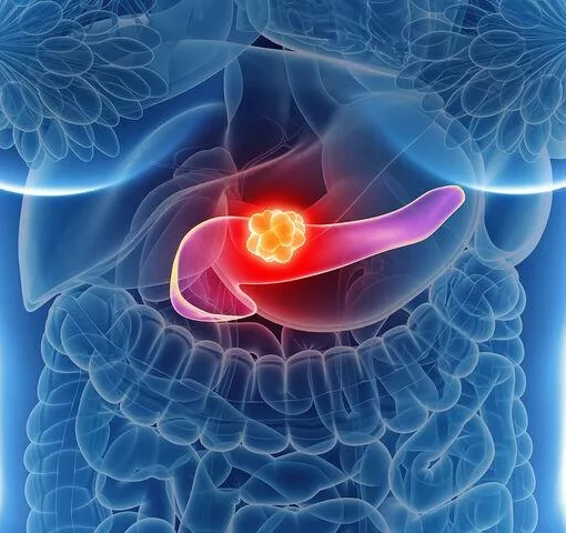 pancreatic cancer