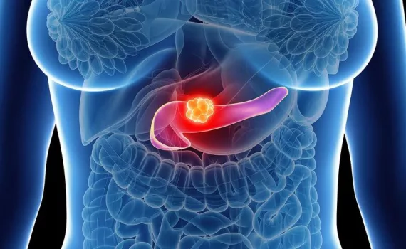 pancreatic cancer